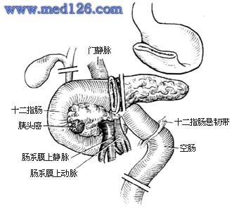 胰十二指肠切除术