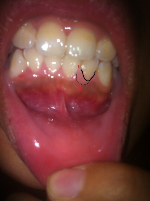 下牙龈边缘有条紫红色的线但是不痒不痛的是怎么回事啊