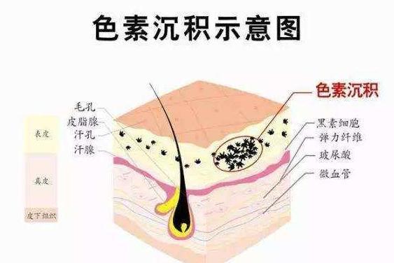 皮肤色素沉着 搜狗百科