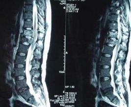 症 脊椎 管 狭窄 足のむくみ放置すると最悪切断の可能性も・・・｜脊柱管狭窄症の落とし穴